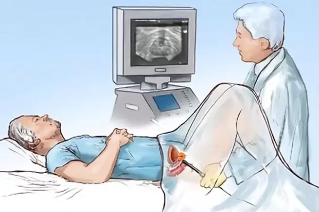 prostatīta diagnostika