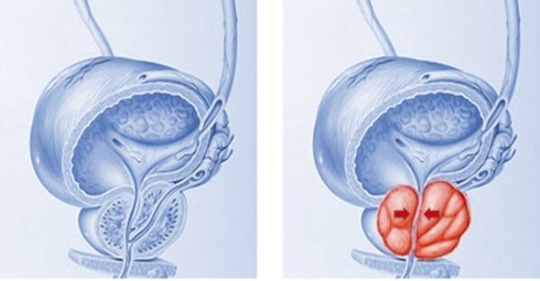 vesela un iekaisusi prostata ar prostatītu